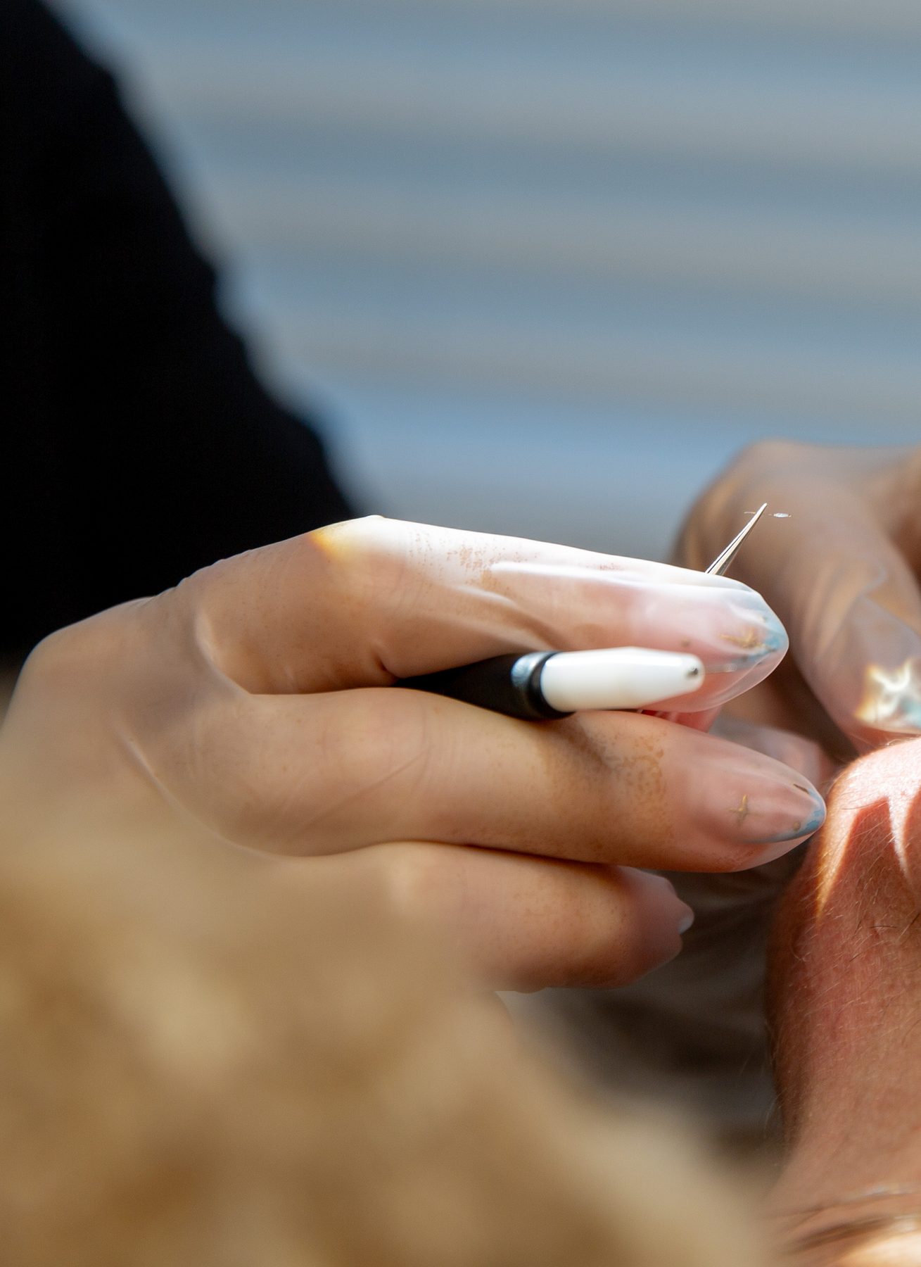 Close-up of an electrolysis treatment in progress